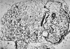 F,55y. | leiomyosarcoma - omentum